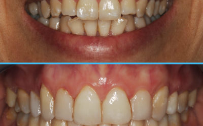 Caso 11_Encarna Caso 11 – Dolor oro facial, Reabsorción bicondilar, D.C.M. y solución interdisciplinaria (Parte 1 – 2009 hasta 2014 y Parte 2 – 2014 a 2020 MODJAW)