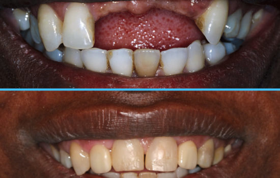 Caso 5 – Ortodoncia regeneradora en la ausencia de tres dientes anteriores