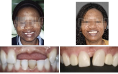 Caso 5 – Ortodoncia regeneradora en la ausencia de tres dientes anteriores