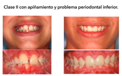 Caso 15 C – Clase II con apiñamiento y problema periodontal inferior en paciente infantil
