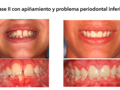Caso 15 C – Clase II con apiñamiento y problema periodontal inferior en paciente infantil